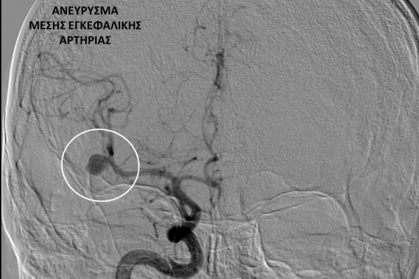 Αγγειογραφία εγκεφάλου / Ανεύρυσμα μέσης εγκεφαλικής αρτηρίας