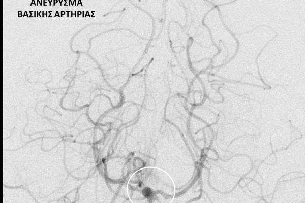 Αγγειογραφία εγκεφάλου / Ανεύρυσμα βασικής αρτηρίας