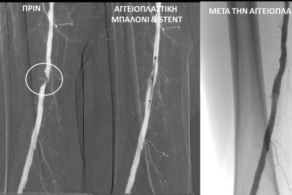 Αγγειοπλαστική επιπολής μηριαίας αρτηρίας με μπαλόνι και stent