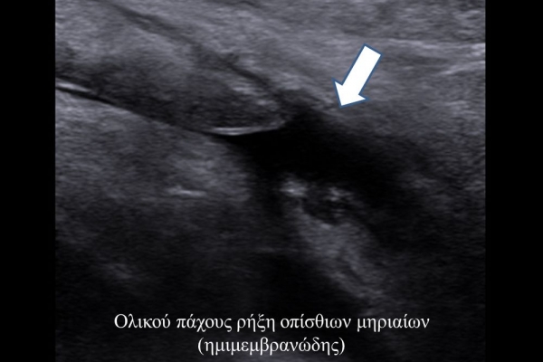 Δυναμικός υπερηχογραφικός έλεγχος γόνατος_ολική ρήξη ημιμεμβρανώδους τένοντα