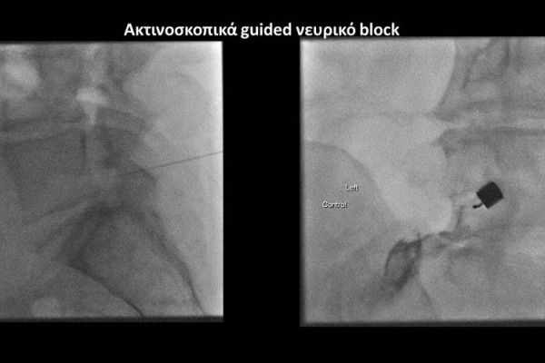Νευρικό block υπό ακτινοσκοπική καθοδήγηση Ο5Ι1