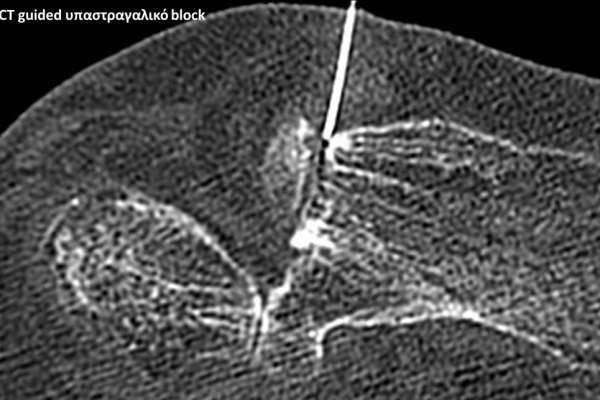 Υπαστραγαλικό block υπό CT καθοδήγηση