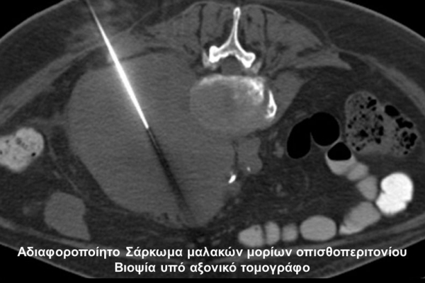 Βιοψία υπό αξονικό τομογράφο_αδιαφοροποίητο σάρκωμα μαλακών μορίων οπισθοπεριτοναίου