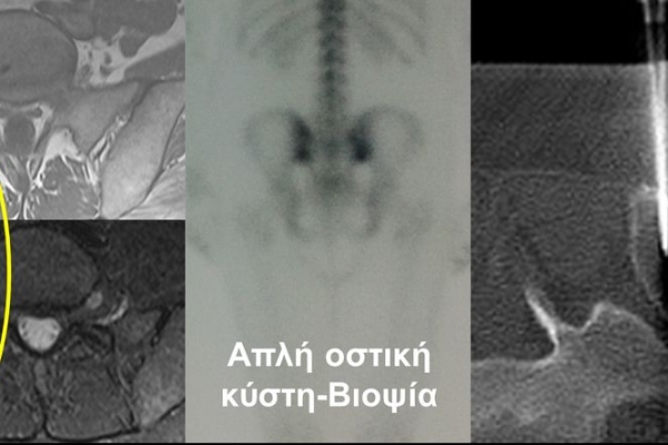Βιοψία υπό αξονικό τομογράφο / απλή οστική κύστη