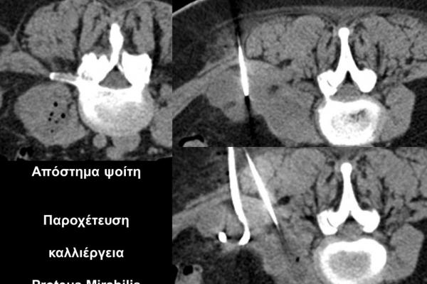 Βιοψία υπό αξονικό τομογράφο / απόστημα μαλακών μορίων