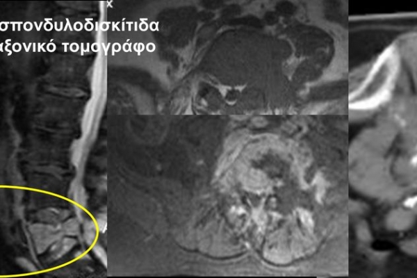 Βιοψία υπό αξονικό τομογράφο / φυματιώδης σπονδυλοδισκίτιδα