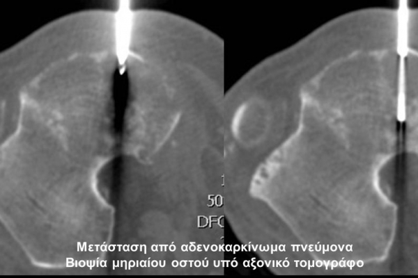 Βιοψία υπό αξονικό τομογράφο_μετάσταση μηριαίου οστού από αδενοκαρκίνωμα πνεύμονα