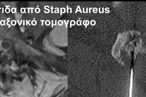 Βιοψία υπό αξονικό τομογράφο / σηπτική αρθρίτιδα αποφυσιακής άρθρωσης