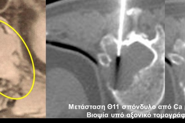 Βιοψία υπό αξονικό τομογράφο / σπονδυλική μετάσταση από Ca μαστού