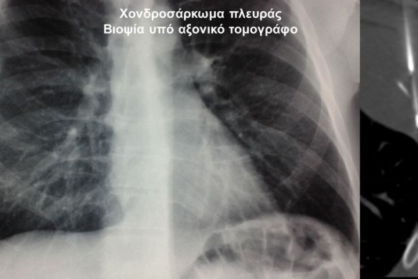 Βιοψία υπό αξονικό τομογράφο / χονδροσάρκωμα πλευράς