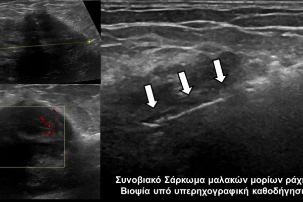 Βιοψία υπό υπέρηχογραφική καθοδήγηση_Συνοβιακό Σάρκωμα μαλακών μορίων ράχης