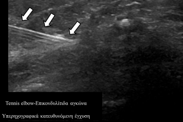Υπερηχογραφικά κατευθυνόμενη έγχυση / επικονδυλίτιδα αγκώνα