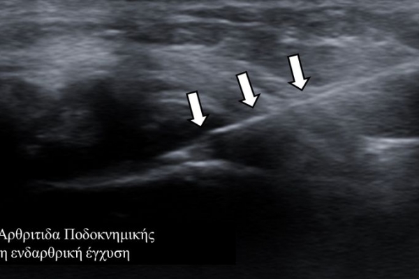 Υπερηχογραφικά κατευθυνόμενη έγχυση / ρευματοειδής αρθρίτιδα ποδοκνημικής