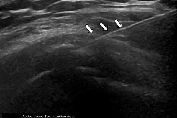 Υπερηχογραφικά κατευθυνόμενη θεραπεία barbotage / ασβεστοποιός τενοντοπάθεια ώμου