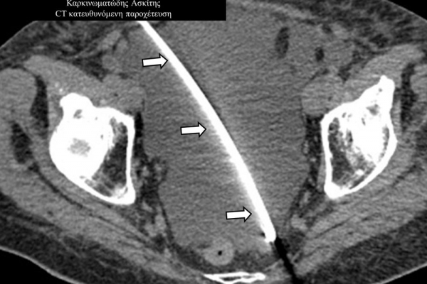 Καρκινωματώδης Ασκίτης / CT κατευθυνόμενη παροχέτευση