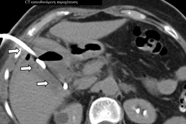 Απόστημα μετά από χολοκυστεκτομή / CT κατευθυνόμενη παροχέτευση