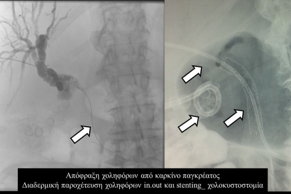 Διαδερμική παροχέτευση χοληφόρων in.out και stenting / χολοκυστοστομία