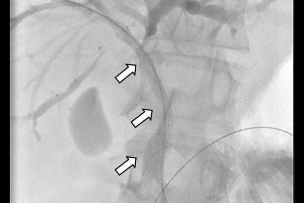 Διαδερμική παροχέτευση χοληφόρων / stenting