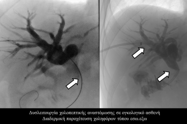 Διαδερμική παροχέτευση χοληφόρων τύπου εσω.εξω