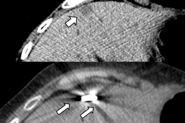 Διαδερμική θερμοκαυτηρίαση / MW Ablation ηπατικής μετάστασης καρκινώματος ενδομητρίου