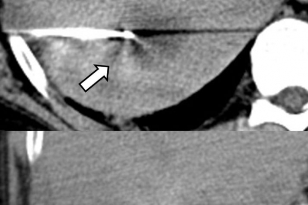 Διαδερμική θερμοκαυτηρίαση / MW Ablation ηπατικής μετάστασης καρκίνου παχέος εντέρου