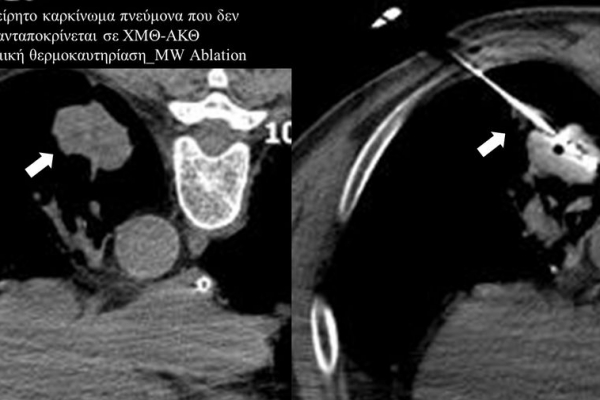 Διαδερμική θερμοκαυτηρίαση / MW Ablation πρωτοπαθούς καρκινώματος πνεύμονα