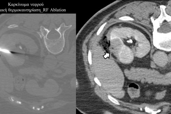 Διαδερμική θερμοκαυτηρίαση / RF Ablation καρκινώματος νεφρού