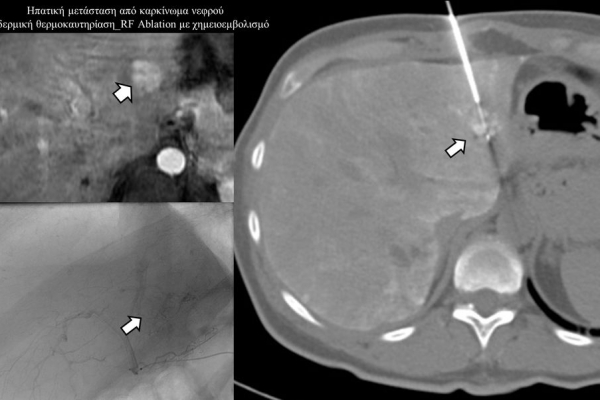Διαδερμική θερμοκαυτηρίαση / RF Ablation με χημειοεμβολισμό
