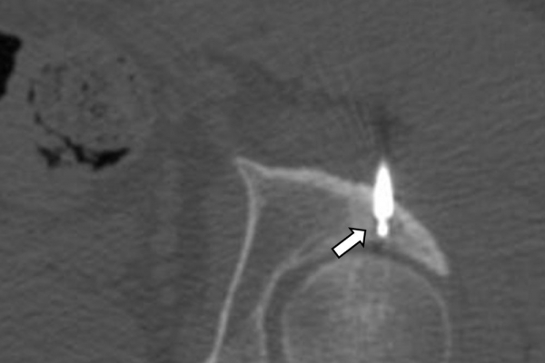 Διαδερμική θερμοκαυτηρίαση / RF Ablation οστεοειδούς οστεώματος