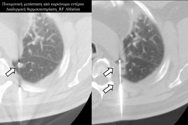 Διαδερμική θερμοκαυτηρίαση / RF Ablation πνευμονικής μετάστασης καρκίνου παχέος εντέρου