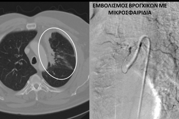 εμβολισμός βρογχικών αρτηριών σε ασθενή με καρκίνο πνεύμονα και ενεργό αιμόπτυση
