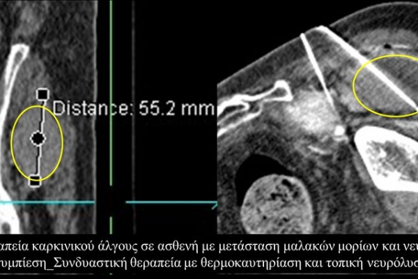 Συνδυαστική θεραπεία πόνου με θερμοκαυτηρίαση και τοπική νευρόλυση σε μετάσταση μαλακών μορίων