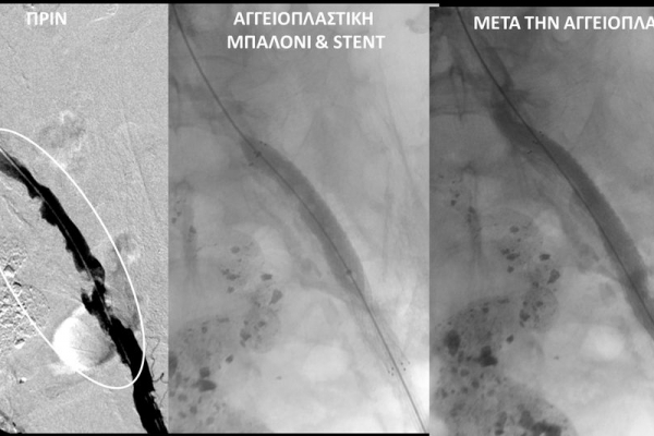 Αγγειοπλαστική έξω λαγονίου σε χρόνιο νεφροπαθή με εξελκωμένη αθηρωματική πλάκα.png