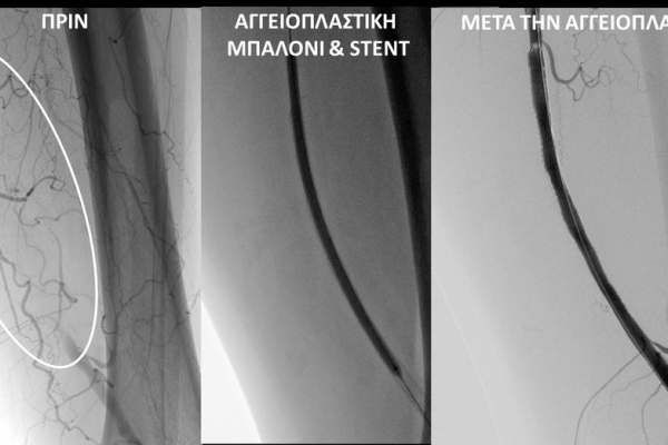 Αγγειοπλαστική χρόνιας ολικής απόφραξης επιπολής μηριαίας αρτηρίας με μπαλόνι και stent