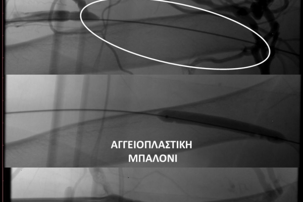 Φιστουλογραφία και αγγειοπλαστική  σε αιμοκαθαιρόμενο ασθενή με ΧΝΑ και πλήρης απόφραξη απαγωγού φλέβας